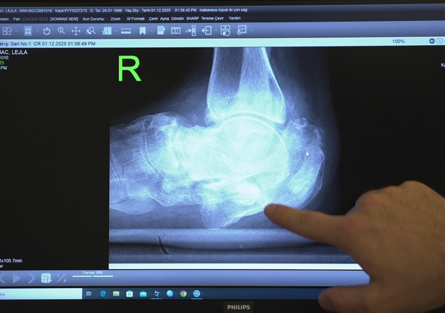 Sırbistan’da “ayağın kesilecek” dediler, Türkiye’de yeniden yürüdü! Medipol’de uygulanan tedavi sayesinde... - Resim: 0